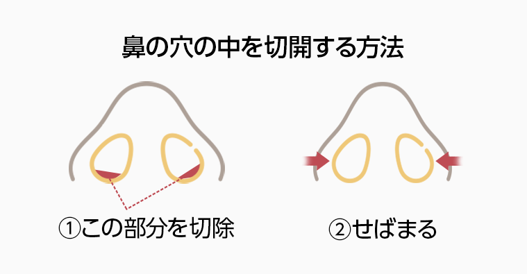 鼻の穴の中を切開する方法